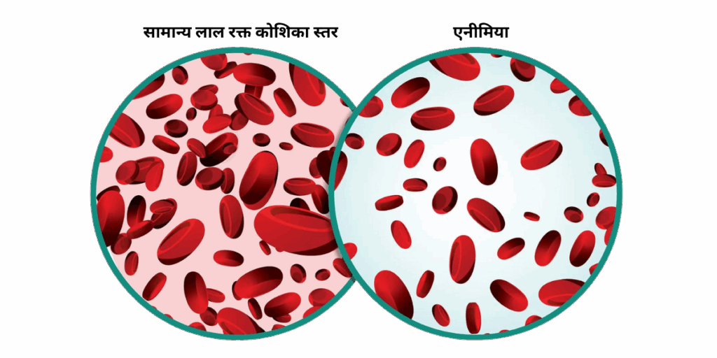 एनीमिया क्या है